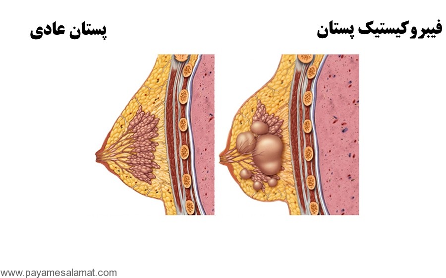 پستان فیبروکیستیک-Fibrocystic-breasts