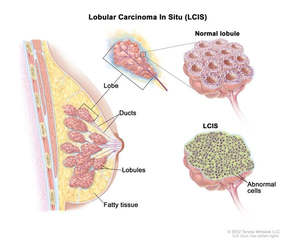 کارسینوم لوبولار درجا (LCIS)
